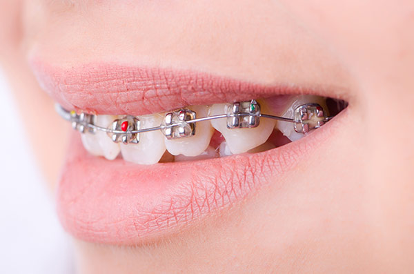 A teenager correcting their crooked teeth problems through orthodontic treatment.