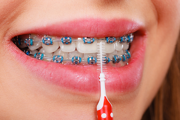 A useful attachment for cleaning braces for orthodontic patients