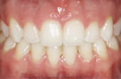 front and bottom teeth after clear braces
