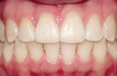 front and bottom teeth after invisalign treatment