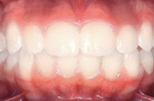 front and bottom teeth after metal braces
