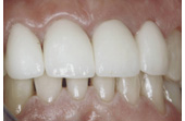 After Crowns & Whitening