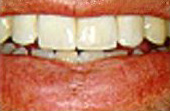 After Dental Crowns - All-porcelain crowns