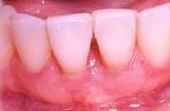 After Cosmetic Gum Enhancement Surgery
