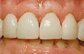 After Veneers - Veneers are shells of porcelain that are bonded onto the fronts of teeth