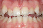 front and bottom teeth before clear braces