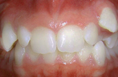 front and bottom teeth before metal braces