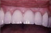 After Bridges - Bridges replace one or more missing teeth