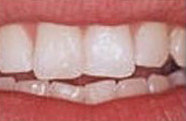 After Contour & Reshape - Procedure used to change the length, shape or surface contours of teeth