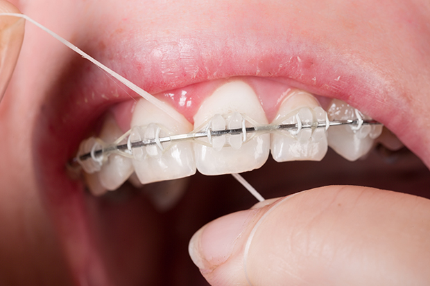 close up of a person with braces flossing their teeth - Is a waterpik a good alternative to flossing