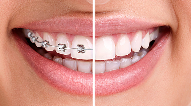 close up of woman's smile and teeth, half with invisalign and half with braces - invisalign vs. braces