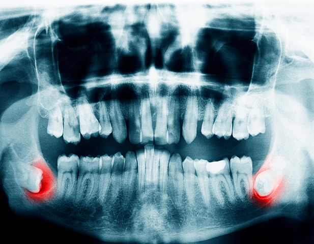 Panoramic X-ray showing impacted wisdom teeth - is it wise to get wisdom teeth removed