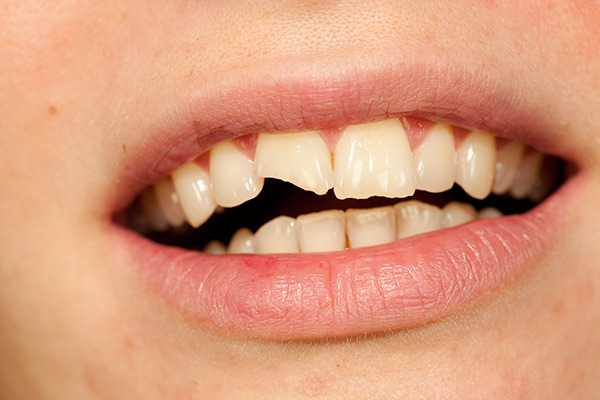 Close up of a mouth with a chipped tooth and cracked tooth enamel.