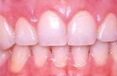 After Cosmetic Gum Enhancement Surgery