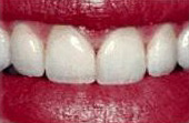After Teeth Bonding - Teeth bonding is a method for repairing minor imperfections in teeth