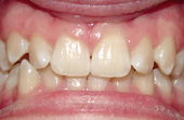 front and bottom teeth before invisalign treatment