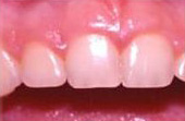 Before Cosmetic Gum Enhancement Surgery