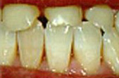 Before Dental Crowns