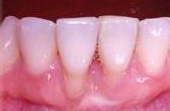 Before Cosmetic Gum Enhancement Surgery