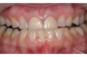 Before Porcelain Reconstruction