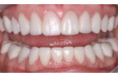 After Porcelain Reconstruction